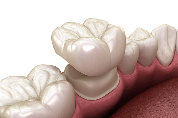 What Can Dental Crowns Do for Your Oral Health Issues? from Dazzling Smile Dental Group in Bayside, NY