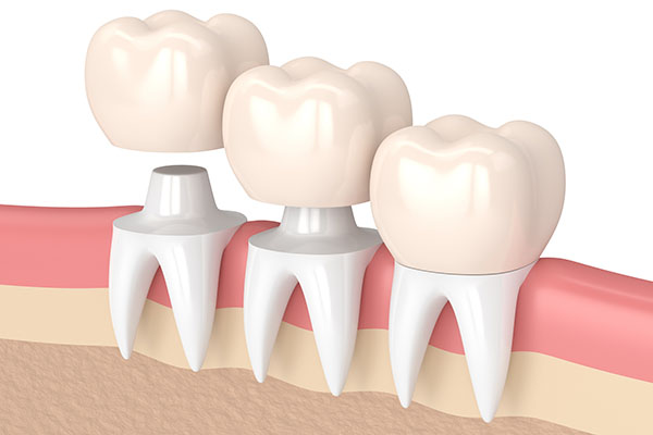 Three Tips to Deal With a Loose Dental Crown from Dazzling Smile Dental Group in Bayside, NY