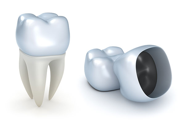 Is a Dental Crown Recommended for Dealing with a Cracked Tooth? from Dazzling Smile Dental Group in Bayside, NY