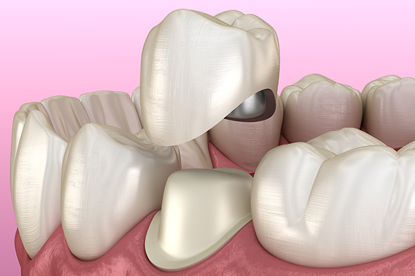 Options for Dental Crown Material from a General Dentist from Dazzling Smile Dental Group in Bayside, NY