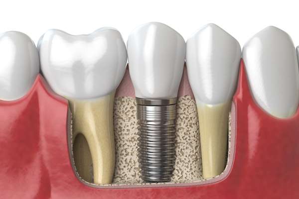 Dental Implants for Replacing Missing Teeth from Dazzling Smile Dental Group in Bayside, NY