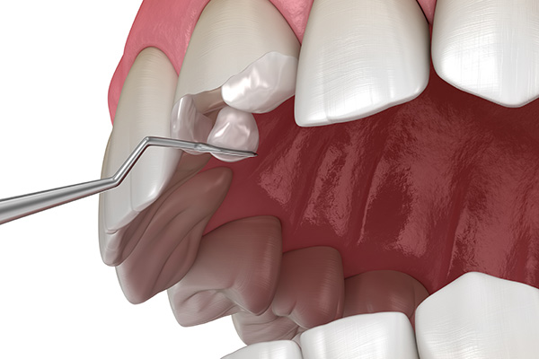 How a General Dentist May Treat a Broken Tooth from Dazzling Smile Dental Group in Bayside, NY