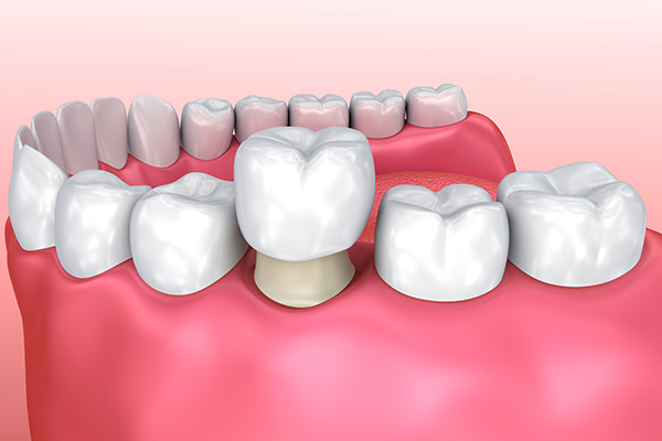How a General Dentist Uses Crowns to Repair Teeth from Dazzling Smile Dental Group in Bayside, NY