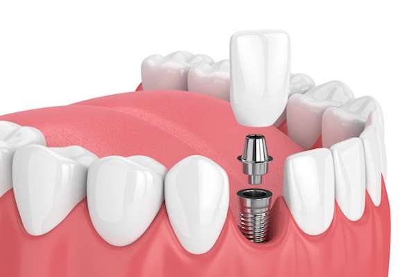 Mini vs. Regular Dental Implants from Dazzling Smile Dental Group in Bayside, NY
