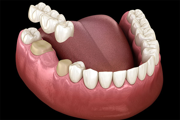 When a Dental Bridge Is a Cosmetic Dental Services Option from Dazzling Smile Dental Group in Bayside, NY