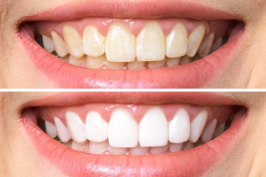 Maintaining Your Dental Veneers: Tips for Long-Term Success