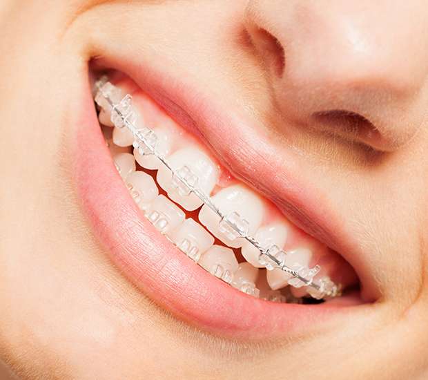 Bayside Clear Braces
