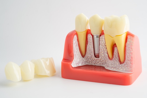 Why Choose Dental Implants Over A Dental Bridge?