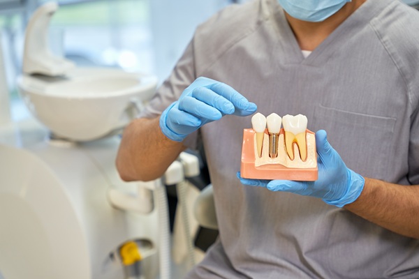 How Long Do Dental Implants Really Last?