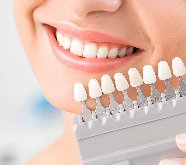 Bayside Veneers