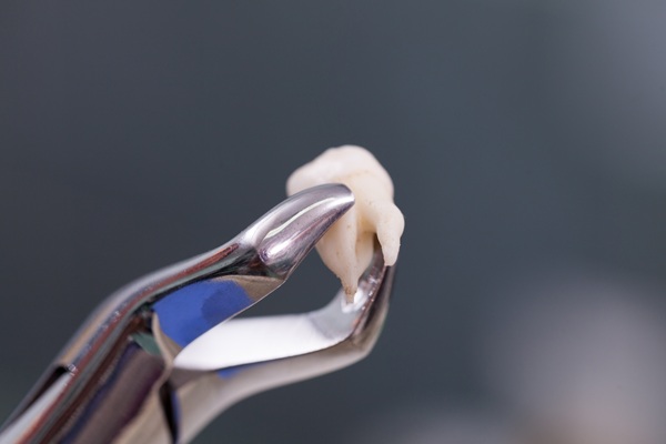 Emergency Tooth Extraction For A Severely Damaged Tooth